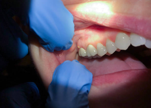 Best Emergency Treatment for Dental Infections or Abscesses in Bent, NE